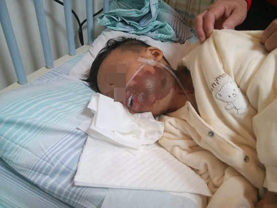 武冈3岁男童误服浓硫酸重度灼伤