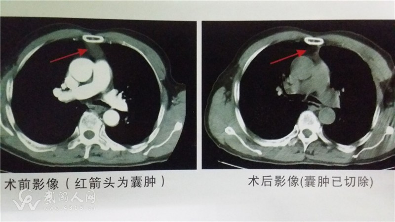 武岡首例全胸腔鏡腫瘤微創(chuàng)切除術(shù)成功