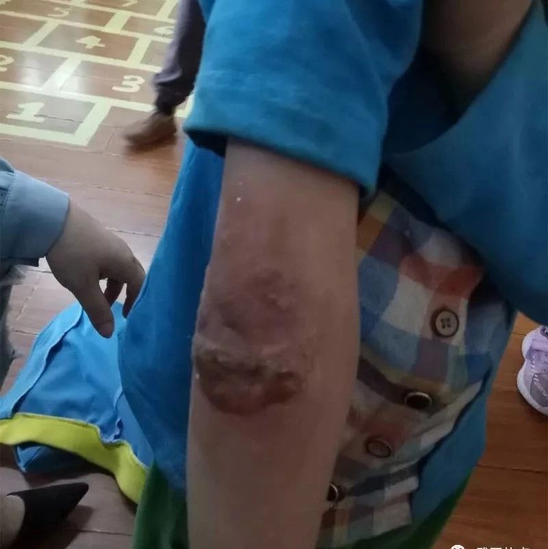 武岡新光幼兒園一大班學(xué)生,被父親燙傷